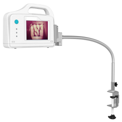 Vein Illuminator